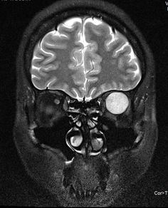 the brain is shown in black and white, with an image of a person's head