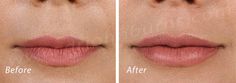 https://flic.kr/p/ZRbYqu | Volbella Lip Filler | Volbella Lip Filler Dr. John L. Burns, Jr., MD Board Certified Plastic Surgeon President, Dallas Plastic Surgery Institute Dream Lips, Lip Color Tattoo, Body Inspiration