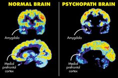 two mri images show the different areas of the brain and how they are related to each other