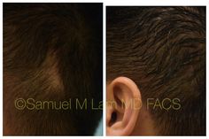 Scar Revision, Fue Hair Transplant, Hair Transplant, When He, A Child, Diet, Hair