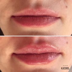 Botox Lip Flip, Lip Flip, Botox Before And After, Small Lips, Lip Enhancement, Under The Knife, Lip Injections