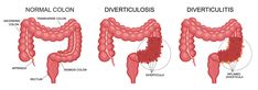 Sigmoid Colon, Regular Bowel Movements, Prevent Constipation, Irritable Bowel, Lifestyle Habits, Abdominal Pain, Genetic, Herbal Remedies