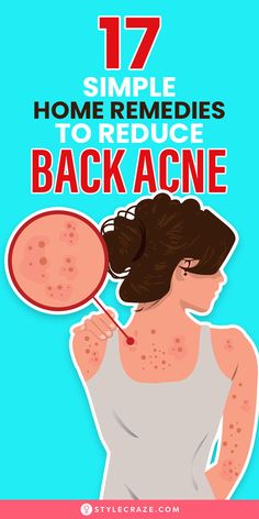 Back acne is challenging and annoying since it is difficult to see and hard to reach. Just like acne on any part of your body, back acne may be a result of clogged pores or a medical condition.