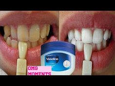 Teeth Whiting At Home, Vaseline Original, Brow Tutorial, Diy Teething, Charcoal Teeth Whitening, Teeth Whitening Pen, Yellow Teeth, Teeth Whitening Strips, Teeth Health