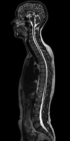 an x - ray image of the back of a person's head and neck