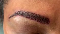 Dallas African-American Eyebrow Hair Transplant Immediately After Close-Up African American Women, American Women, African American, Close Up, Dallas