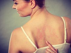 Souvent considérées comme des "fausses" maladies, les maladies psychosomatiques sont pourtant bien réelles. ... Home Remedies For Rashes, Vitamin Deficiency, Tanning Bed, Vitamins For Skin, Skin Cream, Vitamin D, Migraine, Skin Problems, Skin Conditions