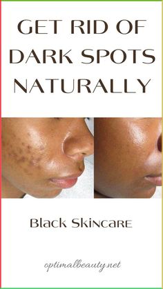 How to get clear skin. Oily skin. Black women. Acne. Skin care. Black skin care. Hyperpigmentation. Dark spot corrector. Black Skin Care Dark Spots, Oily Skin Remedy, Bad Acne, Dark Spots On Face, Black Skin Care, Spots On Face, Remove Dark Spots, Facial Skin