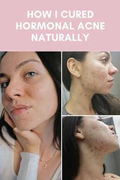 How To Balance Hormones, Chin Acne, Balance Hormones Naturally, Hormonal Imbalance, Balance Hormones