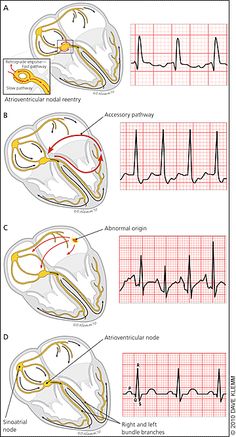 three diagrams showing the different stages of an animal's ectomtical resection