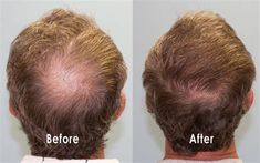 Crown Hair Loss Regrowth. There are any references about Crown Hair Loss Regrowth in here. you can look below. I hope this article about Crown Hair Loss Regrowth can be useful for you. Please remember that this article is for reference purposes only. #crown #hair #loss #regrowth Hair Surgery, Hair Crown, Crown Hair, Hair Restoration, Crown Hairstyles, Haircut Ideas, Long Hair Cuts