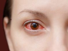 Remedies For Tooth Ache, Itchy Eyes, Pink Eye, Improve Blood Circulation, Dry Eyes, Pink Eyes