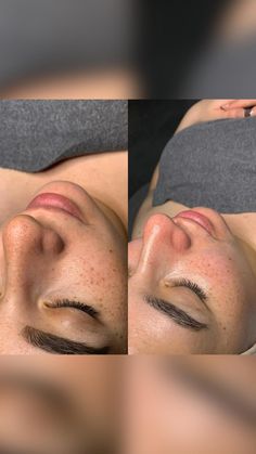 Chemical Face Peel, Facial Before And After, Microdermabrasion Benefits, Exfoliation Benefits, Dental Wallpaper, Facial Benefits, Cell Metabolism, Facial Room, Microdermabrasion Facial