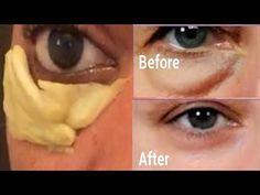 For personal questions, to buy natural ingredients, for a quick response, click this link. https://editorial556.com  and ask I will be there to answer all yo... How To Remove Bags Under Eyes Fast, Bags Under Eyes Remedy Diy, Baggy Under Eyes, Reduce Under Eye Puffiness, How To Remove Eye Bags, Baggy Eyes Remedy, Vaseline Under Eyes, Undereye Bags Remedy, Eye Bag Remedies