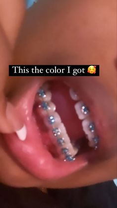 Braces Colors Two Colors, Tightening Braces, Straight Teeth With Braces, Braces Y2k, Braces Colors Ideas Dark Skin Women, Light Green Braces, Royal Blue Braces Teeth, Light Pink Braces Aesthetic, Braces Inspo Colors