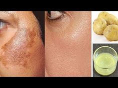 Botox Tips, Remedies For Hyperpigmentation, Skin Spot Remover, Skin Care Routine For 20s, Skin Pigmentation, Acne Scar Removal