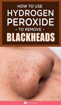 Hydrogen peroxide is the universal go-to ingredient when it comes to skincare. Read this article to how to use hydrogen peroxide to remove blackheads safely. Mascara Hacks, To Remove Blackheads, Blackhead Mask, Home Remedy For Cough, Remove Blackheads, Natural Cough Remedies, Cold Sore