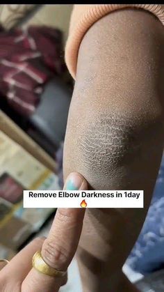 Dark Elbows And Knees, Castor Oil Eyelashes, Dark Elbows, Teeth Whitening Homemade, Grooming Ideas, Underarm Hair Removal, Natural Skin Care Remedies, Rid Of Blackheads, Tan Removal