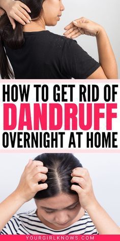 Get Rid Of Dandruff Fast, What Is Dandruff, How To Remove Dandruff, Expensive Shampoo, Severe Dandruff, Natural Dandruff Remedy, Dandruff Hair