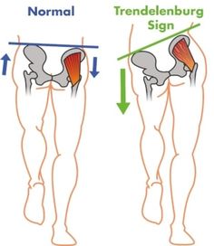 3 Steps to Eliminating Tensor Fasciae Latae Pain Gluteus Medius Exercises, Patellofemoral Pain Syndrome, Gluteus Medius, Knee Exercises, Strengthening Exercises