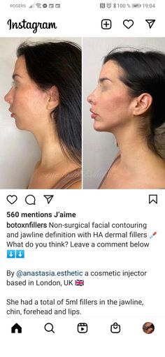 Chin Filler, Facial Contouring, Dermal Fillers, Plastic Surgery, Surgery, Beauty Hacks, Facial, Lips