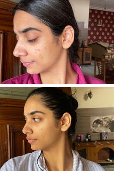 Here Are 11 Best The Ordinary Products For Acne Scars That CHANGED My Skin Different Types Of Acne, Facial Scars, Oily Skin Care Routine