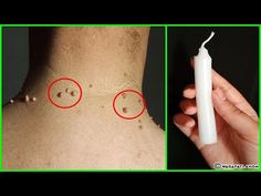 Remove Skin Tags, Remove Skin Tags Naturally, Tag Remover, Lifting Facial, Mole Removal, Get Rid Of Warts, Skin Tags, Single Candle, Skin Care Remedies