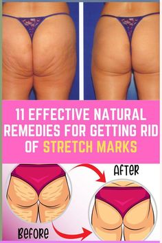 cellulite, cellulite treatment, stretch marks, stretch marks removal, stretch mark remedies. #cellulite #cellulitetreatment #stretchmarks #stretchmarksremoval #stretchmarkremedies. Strech Marks Removal, Stretch Mark Removal Cream, Strech Marks, Stretch Mark Remedies, Stretch Mark Removal, Stretch Mark Cream, Stretch Mark, Muscle Aches, Loose Skin