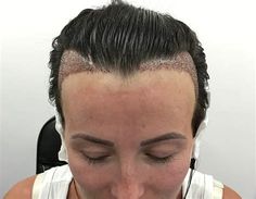 Female Hair Transplant Near Me. There are any references about Female Hair Transplant Near Me in here. you can look below. I hope this article about Female Hair Transplant Near Me can be useful for you. Please remember that this article is for reference purposes only. #female #hair #transplant #near #me Female Hair Transplant, Hair Transplant Women, Female Hair, Horror Music, Hair Transplant