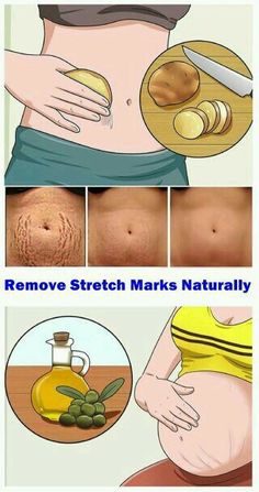 Stretch Mark Remedies, Stretch Mark Removal, Dry Skin Remedies, Natural Pregnancy, Beauty Remedies, Pregnancy Care, Skin Care Remedies, After Pregnancy, Better Skin