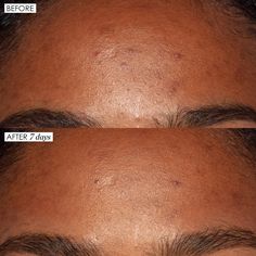 Good Genes deeply exfoliates the dull surface of the skin for instant glow and radiance. As dull, dead surface cells are removed, clarity and smoothness are restored. Good Genes visibly brightens the appearance of dark spots and discolorations and instantly plumps the look of fine lines and wrinkles in 3 minutes. This multi-tasking, targeted lactic acid treatment rapidly exfoliates and boosts naturally youthful radiance, while visibly reducing the look of lines, wrinkles, and dark spots. High po Aha Serum, Botox Face, Skin Bumps, High Hair, Congested Skin, Good Genes, Sunday Riley, Clearer Skin, Skin Disorders