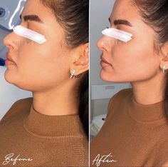 Filler Facial Contouring, Face Plastic Surgery Before After, Pixie Tip Lift Nose Filler, Jaw And Chin Filler, Jaw Line Fillers Before And After, Facial Balancing Before And After, Chin Lipo Before And After