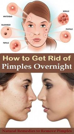 how to get rid of a blind pimple overnight To Remove Pimples, Plantar Warts, Warts Removal, Warts On Hands, Warts On Face, Remove Pimples, How To Remove Warts, Remove Skin Tags