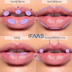 Heavy Lower Lip, Lip Filler Technique, Cosmetic Fillers, Lips Inspiration, Face Fillers