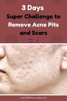 Acne Scar Remedies, Scar Remedies, Acne Scaring, Cold Sores Remedies, Acne Scar Removal, Cold Home Remedies, Natural Cough Remedies, Scar Removal, How To Get Rid Of Acne