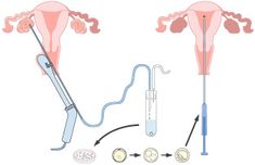 How to Increase Your Chances of Embryo Transfer Success? - the Lucky Egg Egg Retrieval Ivf, Ivf Tips, Ivf Journey, Fertility Doctor, Fertility Health