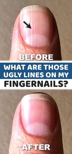 Vertical Nail Ridges, Nail Health Signs, Nail Ridges, Nail Problems, Health Signs, Tongue Health, Lines On Nails, Brittle Nails, Getting Older