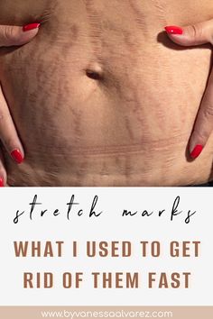 Say Goodbye to Stretch Marks: Remedies for Moms During & After Pregnancy Body Acne Remedies, My Biggest Fear, Purple Streaks, Mom Belly, Doula Business, Biggest Fear, Natural Skin Care Ingredients