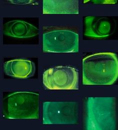 several images of the inside of an eye with green light coming from one side and another part of the viewer's lens