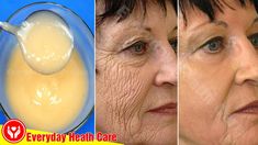 Face Wrinkles Remedies, Wrinkles Remedies Face, Mouth Wrinkles, Wrinkle Remedies, Wrinkle Free Skin, Erase Wrinkles, Younger Skin