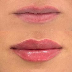 Lip Fillers Juvederm, 1ml Lip Filler, Restylane Lips, Lip Permanent Makeup, Lips Inspiration, Permanente Make-up, Face Fillers, Botox Lips, Aesthetic Dermatology