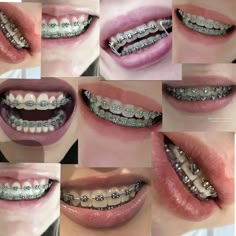 Brace Aesthetics, Good Colors For Braces, Teeth Braces Aesthetic, Braces Aesthetic Colors, Braces Colors Aesthetic, White Teeth With Braces, Orthodontics Aesthetic