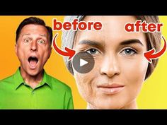 10K views · 212 reactions | STOP Aging and Look YOUNGER! - Dr. Eric Berg DC | STOP Aging and Look YOUNGER! - Dr. Eric Berg DC | By Dr. Eric Berg DC - Your doctor | Today, I'm going to talk about
how to slow down the aging process. If you want to look
younger, live longer, and have fewer diseases, then, this
video is for you. Now, I know I don't look 75 years old, okay?
And it's probably because I'm not 75 years old. I'm fifty9,
but what I'm going to show you is based on a huge deep dive
into this longevity topic. I'm not sure if you've ever heard
of the mitochondria before but the mitochondria is the energy
factory and so you're going to be as healthy or live as long
as your mitochondria is functioning in in good shape.
So without getting into too much biochemistry. If you've
taken a biolo Stop Aging, 10k Views, Aging Process, Biochemistry, Live Long