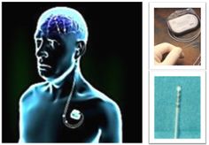 Deep Brain Stimulation (DBS) is a treatment for selected patient suffering from Parkinson’s disease dystonia and most forms of tremors. Surgery Doctor, Cheer Picture Poses, Neurological Disorders, Cheer Pictures, Migraine, Picture Poses