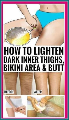 How To Remove Black Marks Under Arms Tiny Shorts, Inner Thigh