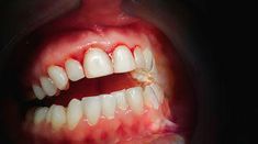 This article provides us with tips that will help us to stop the bleeding gums and prevent it from occurring in the future. Gum Surgery, Round Loom Knitting, Things With Faces, Dental Advertising, Dental Images, Antiseptic Mouthwash, Dental Check Up, Swollen Gum, Dental Exam