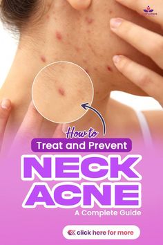 Learn all about the causes, prevention tips, and expert-recommended treatments to bid farewell to pesky neck acne for good. Pimples On Neck, Neck Acne Causes, Neck Pimples, Closed Comedones, Neck Acne, Skin Blackheads, Pimple Free Skin, Pimple Scars