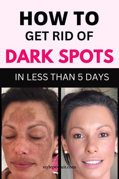 Dark Spots Remedies, Wrinkle Free Skin, Oily Skincare, Dark Spots On Face