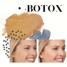 two photos of the same woman's face with botox