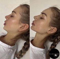 Jawline Before And After, Jaw Implant Before And After, Facial Contouring Fillers, Chin And Jawline Fillers, Square Jaw Reduction, Jawline Surgery, Chin Fillers Before After Round Face, Chin Implant Before And After Women